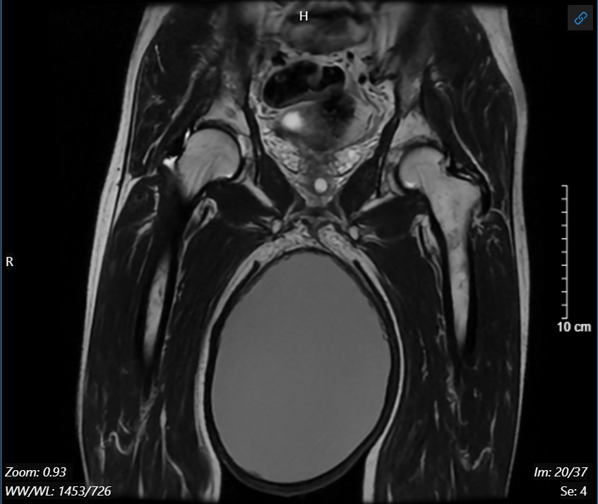 Phim chụp cộng hưởng từ khối u tinh hoàn phải