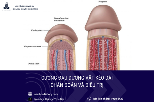 Cương đau dương vật kéo dài: Điều trị