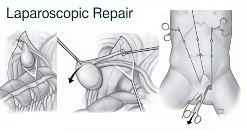 PHẪU THUẬT NỘI SOI HẠ TINH HOÀN ẨN, TINH HOÀN LẠC CHỖ