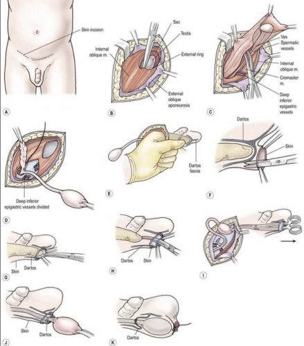 PHẪU THUẬT MỔ MỞ HẠ TINH HOÀN ẨN, TINH HOÀN LẠC CHỖ