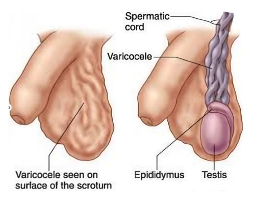 PHẪU THUẬT NỘI SOI THẮT TĨNH MẠCH TINH