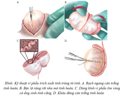 VI PHẪU TRÍCH XUẤT TINH TRÙNG TỪ TINH HOÀN (mTESE)