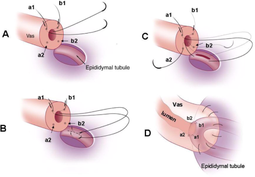 PHẪU THUẬT NỐI ỐNG DẪN TINH - MÀO TINH VI PHẪU