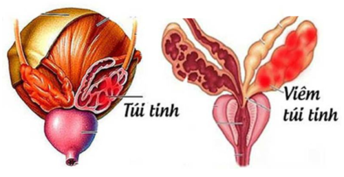PHẪU THUẬT NỘI SOI CẮT TÚI TINH