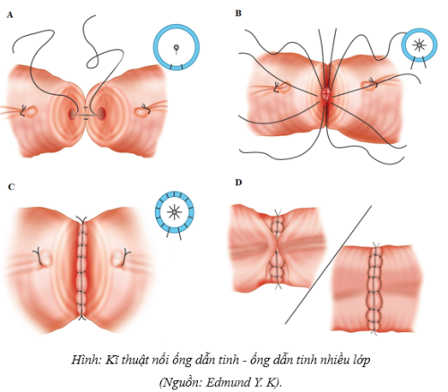 PHẪU THUẬT NỐI ỐNG DẪN TINH VI PHẪU