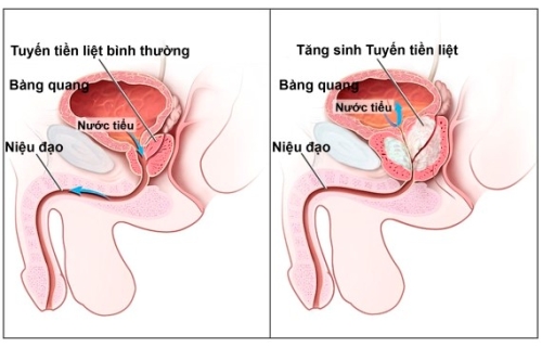 Cương đau dương vật kéo dài: Tổng quan, nguyên nhân và phân loại
