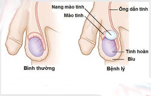 Tràn dịch màng tinh hoàn (phần 2): Triệu chứng lâm sàng, cận lâm sàng