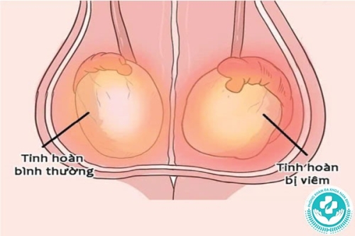 Các phương pháp phẫu thuật tăng sản tuyến tiền liệt: Cập nhật xu hướng mới nhất