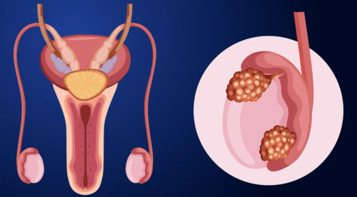 Tràn dịch màng tinh hoàn (phần 3): Các phương pháp điều trị