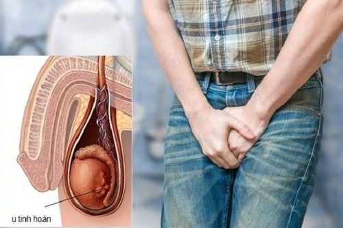 Tràn dịch màng tinh hoàn (phần 1): Tổng quan và các nguyên nhân gây bệnh