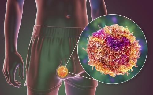 Điều trị giãn tĩnh mạch tinh: Vì sao vi phẫu là 