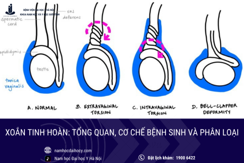 Xoắn tinh hoàn: Tổng quan, cơ chế bệnh sinh và phân loại